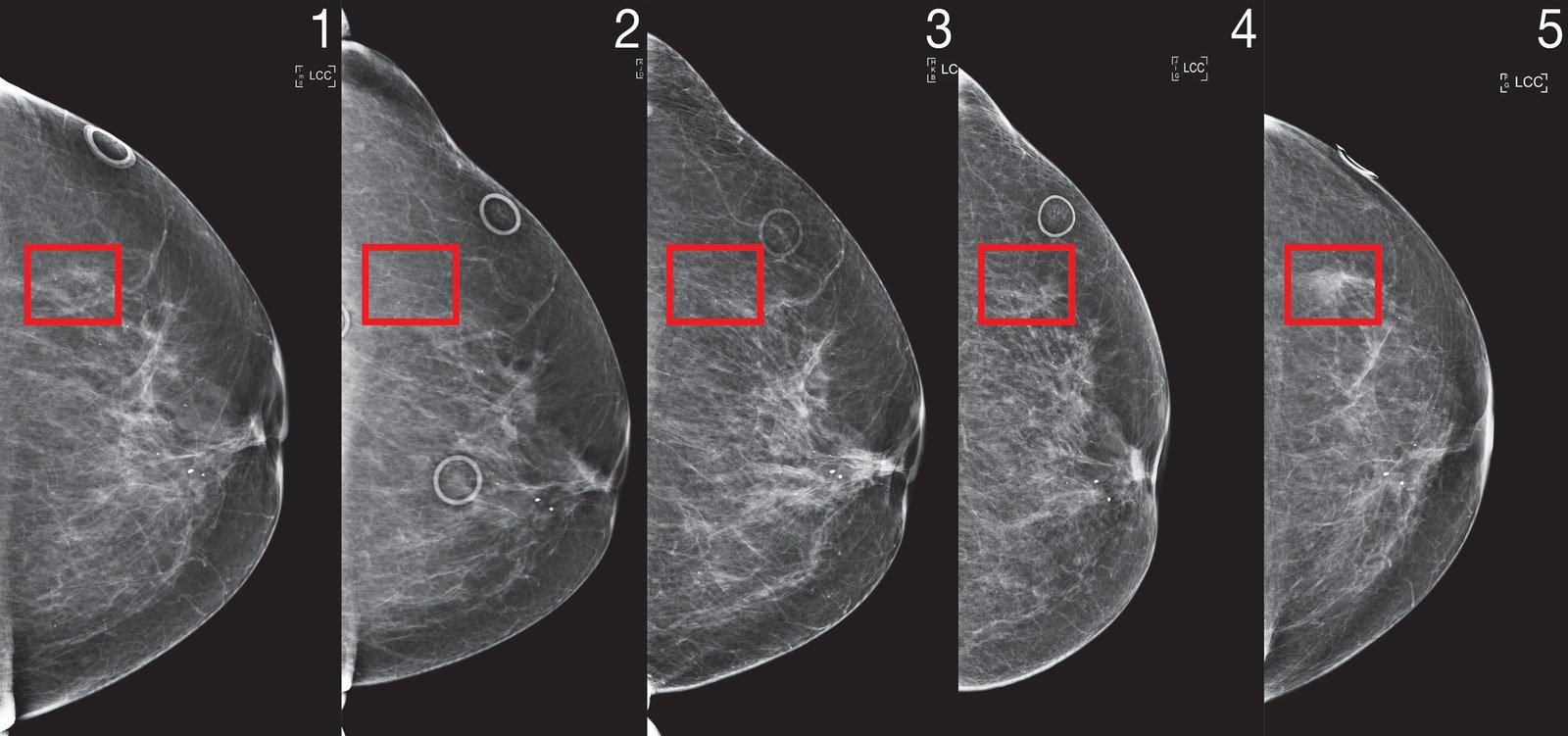 mammogram image